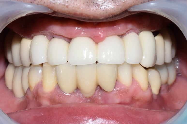 [임플란트/서울역] 서울 상악 전체인플란트 실제사례.극한의 케이스도 관련 이미지 8