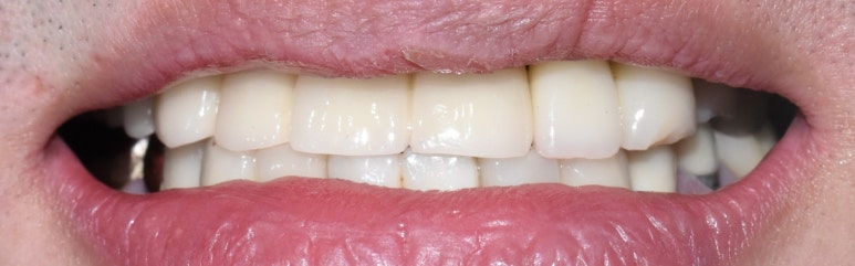 앞니 여러개 임플란트 잘하는 치과 서울역치과 실제사진 관련 이미지 15