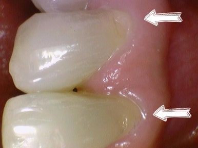 남대문치과 치아가 시리다면? 잇몸패임인가요? 관련 이미지 4