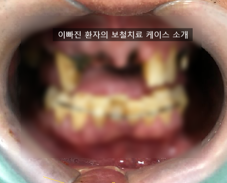 이가 빠졌어요. 이 빠진 환자 보철 환자 케이스 소개 <시청역 연세예감치과> 관련 이미지 3