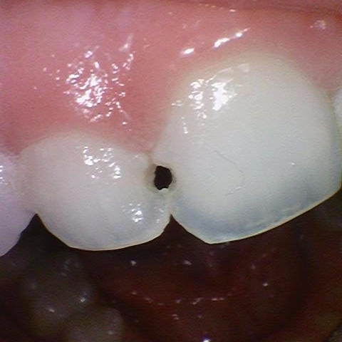 [을지로/명동 근처 치과] 앞니 레진 치료사례 관련 이미지 2
