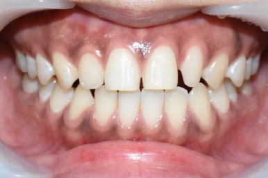 앞니가 작아 고민이신가요? 왜소치 무삭제 라미네이트로 자연스럽게 해결! 해외에서도 찾아오는 치과 비용까지 관련 이미지 8