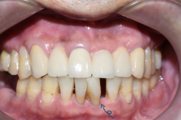 시청역 앞니교정 알아보겠습니다![실제 사례:앞니 하나가 점점 튀어나오고 벌어져요] 관련 이미지 1