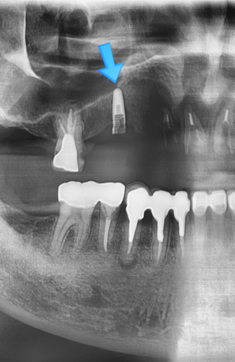 [서울시청역/케이스]"다른 치과에서 한 임플란트가 흔들려서 빼야할 것 같아요" 관련 이미지 3