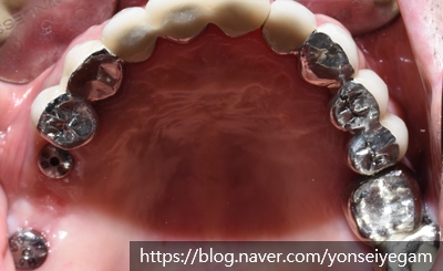 시청역 임플란트&상악동수술?상악동거상술? 어떻게 진행되었을까요 관련 이미지 5