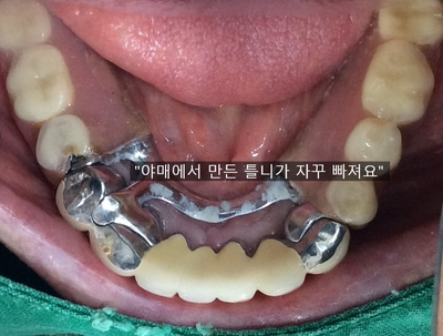 남대문시장가까운치과, 명동,서울역&용산가까운치과, 틀니치료 사례 관련 이미지 16