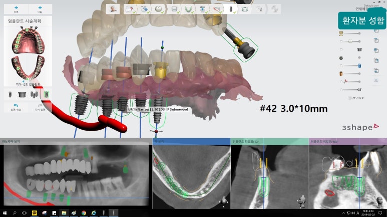 [시청역/을지로] 임플란트 진단 상담 비용? 관련 이미지 5