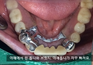 남대문시장&시청역가까운 치과/보험틀니 환자분 스토리 소개 관련 이미지 3