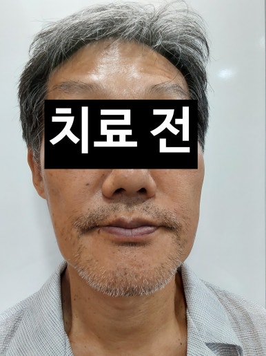 서울 중구 치과/이가 하나도 없는 환자의 치료방법/틀니, 풀아치임플란트, 전체 임플란트 등 관련 이미지 6