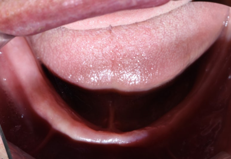 사용중인 틀니가 불편하다면? 임플란트와 틀니가 결합된 임플란트 틀니 추천 관련 이미지 21