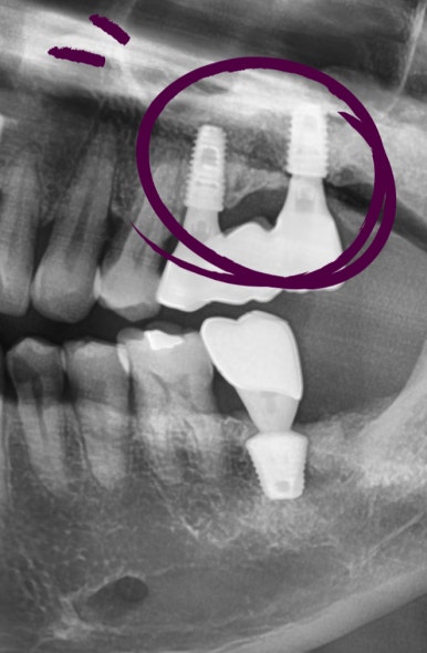 오래된 임플란트가 흔들려요 인플란트 재수술도 서울역가까운치과 연세예감치과 관련 이미지 7