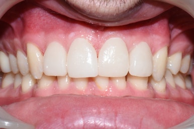 서울시청역치과/ 벌어진 앞니 치아 치료/ 왜소치, 다이아스테마 등/레진, 라미네이트, 부분교정 비교 관련 이미지 18