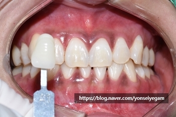 [서울시청역/광화문]치과에서 하는 원데이 치아미백, 연세예감치과에서 알려드려요 관련 이미지 3