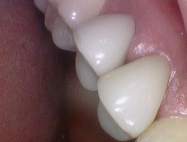 광화문 연세 예감 치과 해외에서도 찾아오는 지르코니아크라운 치료 안내해드려요 관련 이미지 19