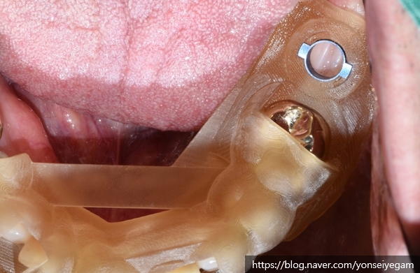 [북창동 치과/연세예감치과]내비게이션임플란트소개 관련 이미지 2