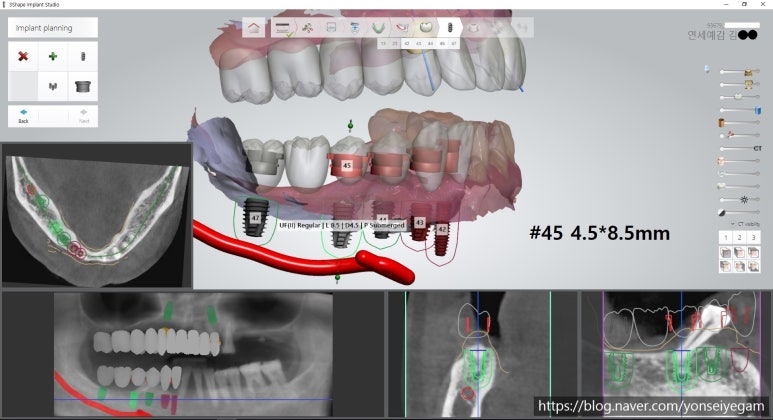 서울역 가까운 치과 시청역치과 연세예감 임플란트 네비게이션임플란트로 다수 임플란트도 빠른수술과 부작용최소화 관련 이미지 3