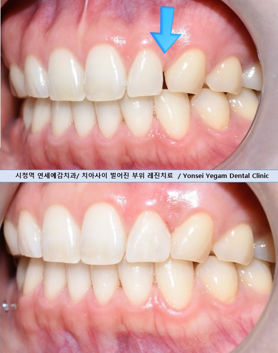 벌어진 앞니 치료, 하루에 가능, 실제케이스 및 가격 비용 관련 이미지 4