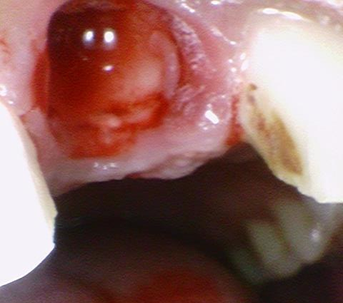 서울시청역 남대문 임플란트 대신에 앞니 브릿지를 한 케이스 관련 이미지 8