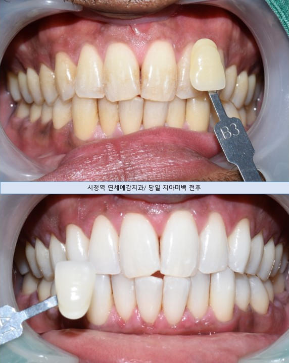 남자분들도 많이 하는 치과 전문가 치아미백 소개드립니다 가격까지 알려드려요 관련 이미지 2