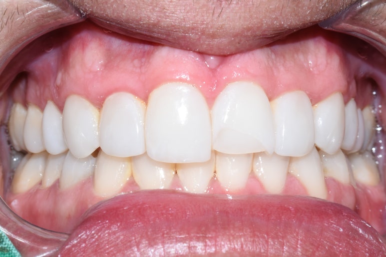 [광화문/연세예감치과] 앞니 치아가 파절되었다면? 앞니 부러짐.레진/크라운/임플란트 관련 이미지 5