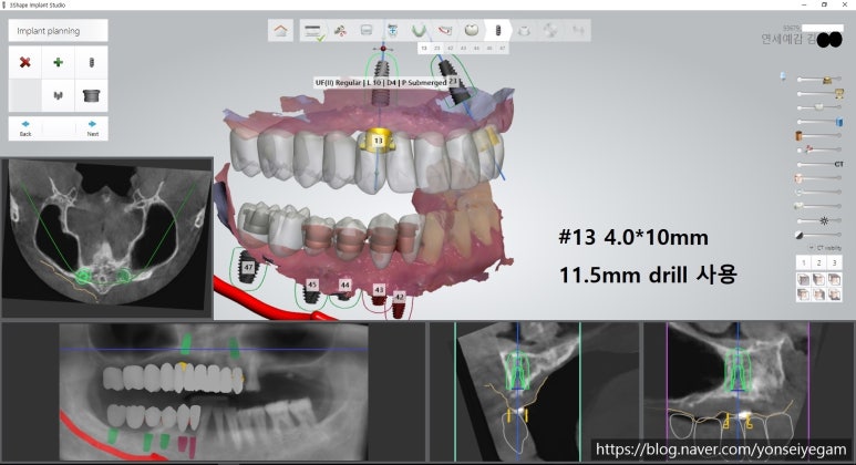 서울역 가까운 치과 시청역치과 연세예감 임플란트 네비게이션임플란트로 다수 임플란트도 빠른수술과 부작용최소화 관련 이미지 8
