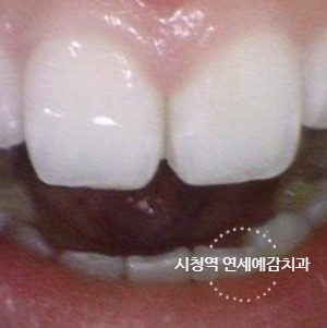 해외에서도 찾아오는 앞니레진치료, 광화문 시청역 서울역 근처 연세예감치과 외국인도 찾는 이유 관련 이미지 2