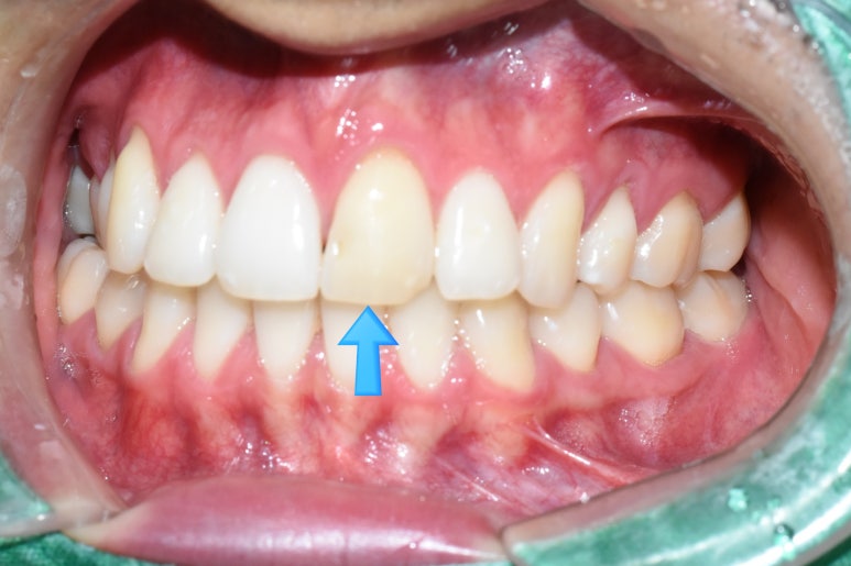 앞니가 변색이 있어서 크라운을 해야하는데 뒤에 교정 유지장치가 붙어있다면? 관련 이미지 2