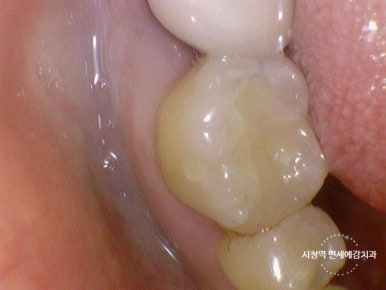 충정로 치과 인레이 해야한다고 들었는데 충치가 안보여요 관련 이미지 15