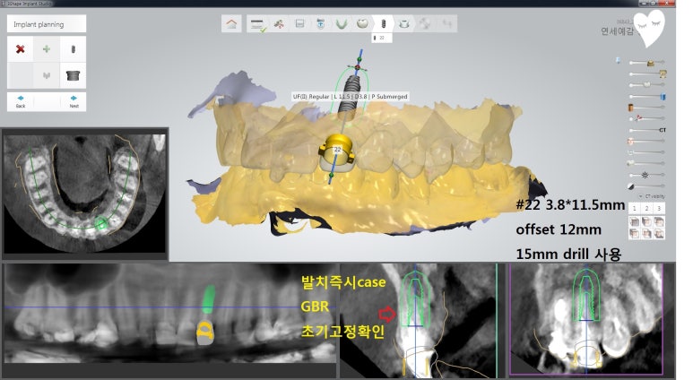 [시청역/서울역 치과] 앞니 치아부러짐 자연스럽게 치료사례 관련 이미지 12