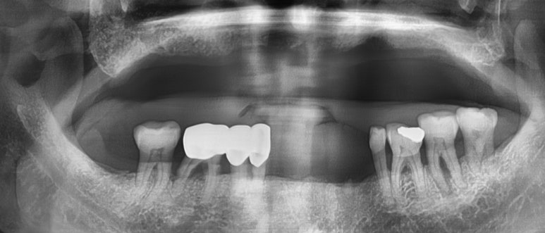 [종로/시청역]실제 환자의 보험 임플란트, 보험 틀니 사례 소개합니다. 젊어지는틀니,임플란트 치료 관련 이미지 4