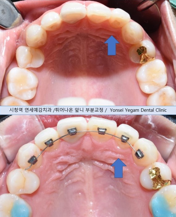 앞니가 삐뚤빼뚤 자기주장이 심하다면? 아무도 모르게 부분교정! 시크릿교정 알아보아요 앞니교정비용 관련 이미지 8