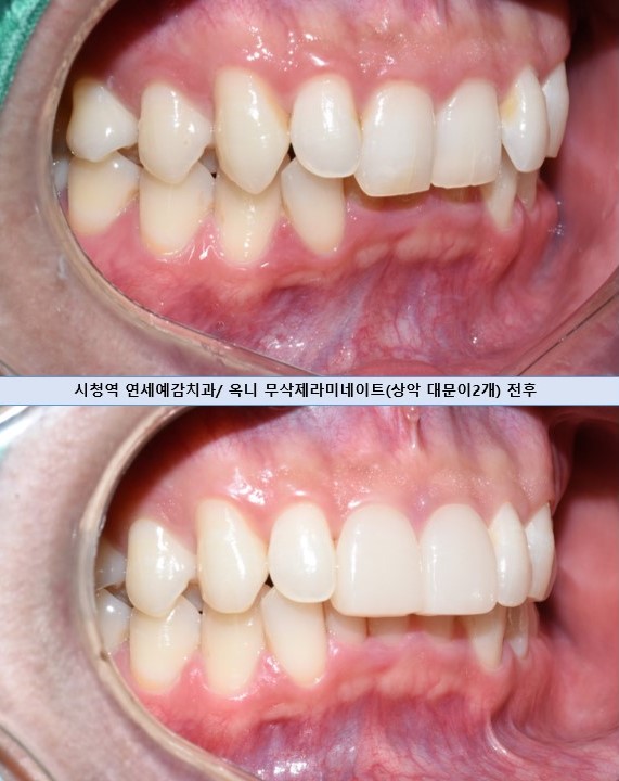 [서울역/치과] 왜소치와 옥니에 특히 추천드리는 무삭제 라미네이트! 관련 이미지 2