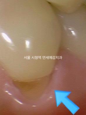 쓰읍하고 바람 들이킬 때마다 이가 시려요 케이스 관련 이미지 1