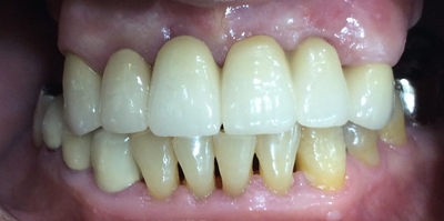 서울 틀니제작, 틀니치료 실제 예입니다. 시청역<연세예감치과> 관련 이미지 11