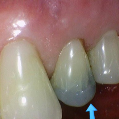 광화문 연세 예감 치과 해외에서도 찾아오는 지르코니아크라운 치료 안내해드려요 관련 이미지 20