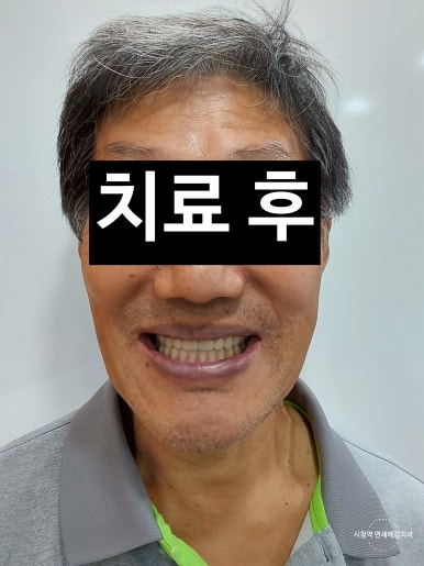 서울 중구 치과/이가 하나도 없는 환자의 치료방법/틀니, 풀아치임플란트, 전체 임플란트 등 관련 이미지 3