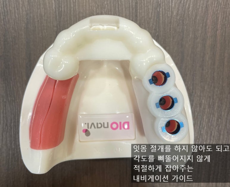 남대문시장 근처 치과 임플란트 연세.예감.치과 관련 이미지 4
