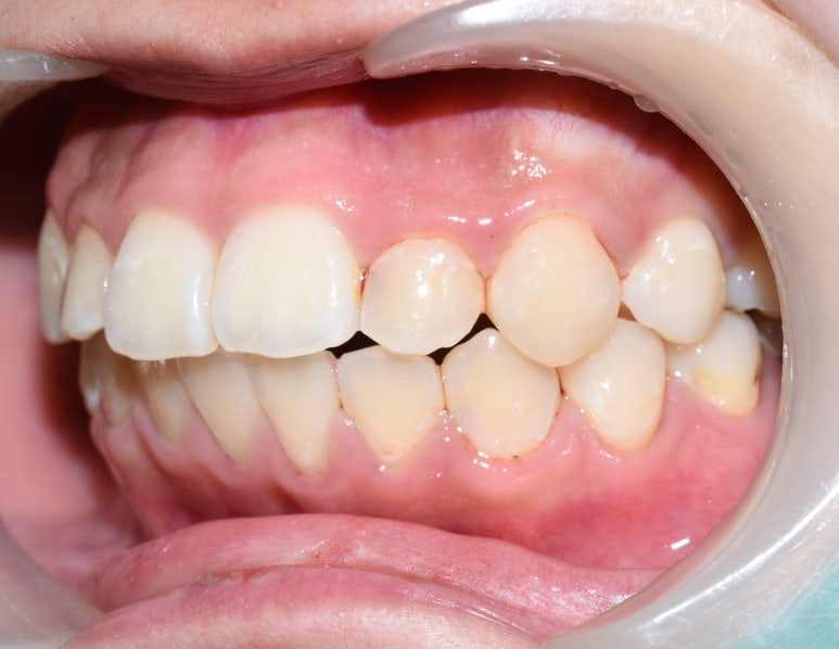 [서울역/시청역] 충치 & 화이트 스팟 (반점치) 의 레진치료케이스 관련 이미지 6