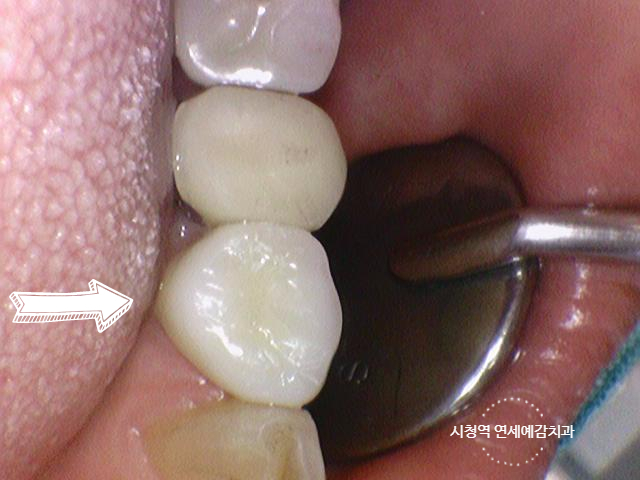 충정로 / 금니, 금크라운, 금인레이,아말감 치아가 보기 싫다면? 치아색 이맥스 인레이,지르코니아 크라운 소개 관련 이미지 5