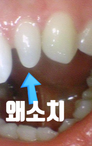 앞니가 작아 고민이신가요? 왜소치 무삭제 라미네이트로 자연스럽게 해결! 해외에서도 찾아오는 치과 비용까지 관련 이미지 1