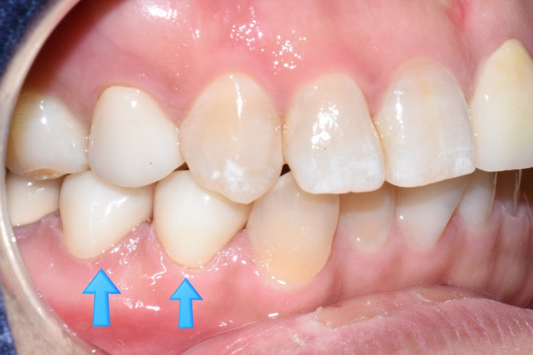 [서대문/광화문]외국인도 찾아오는 치아색나는 크라운, 지르코니아 크라운 치료 치과 어떻게 변하는지 확인해보아요 관련 이미지 7
