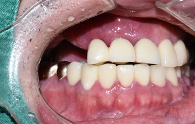 앞니 여러개 임플란트 잘하는 치과 서울역치과 실제사진 관련 이미지 8