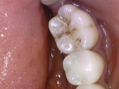 [서울/시청역]어금니 치아가 깨져서 크라운이 필요하다면? 관련 이미지 6