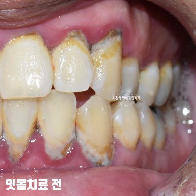 서울시청역 외국인환자 잇몸치료 전후 일주일만에 변화된 사진 관련 이미지 1