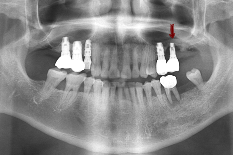 오래된 임플란트가 흔들려요 인플란트 재수술도 서울역가까운치과 연세예감치과 관련 이미지 1