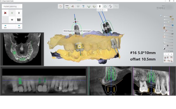 [서울시청역/서울역] 앞니 임플란트 가능할까요? 앞니 내비게이션임플란트 관련 이미지 7