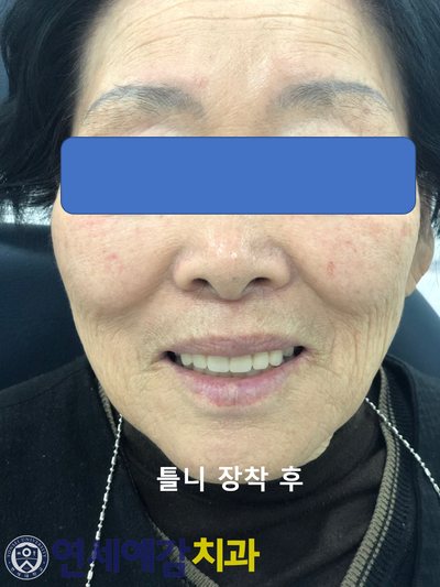 남대문시장가까운치과, 명동,서울역&용산가까운치과, 틀니치료 사례 관련 이미지 8