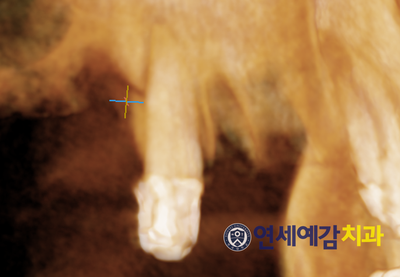 이가 빠졌어요. 이 빠진 환자 보철 환자 케이스 소개 <시청역 연세예감치과> 관련 이미지 4