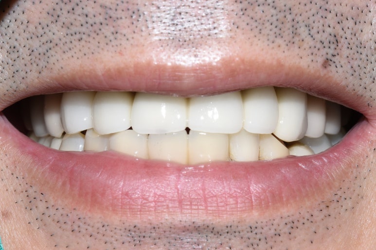 [임플란트/서울역] 서울 상악 전체인플란트 실제사례.극한의 케이스도 관련 이미지 9