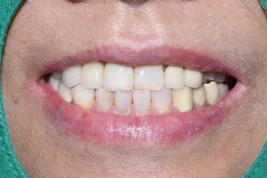 충정로 서울역 근처 고난도 & 재수술 임플란트 수술 치과 관련 이미지 16